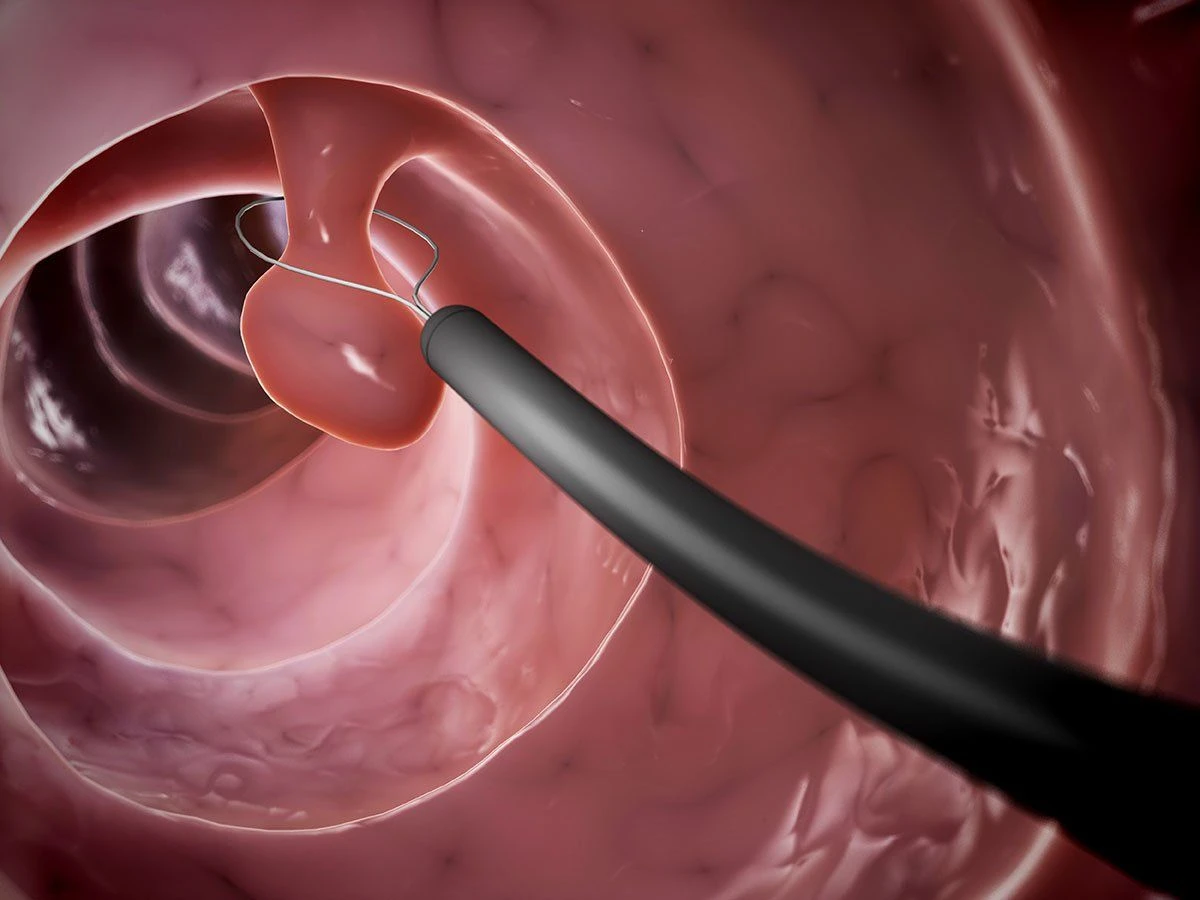 Polyp đại tràng là gì? Dấu hiệu, nguyên nhân và cách xử trí sớm