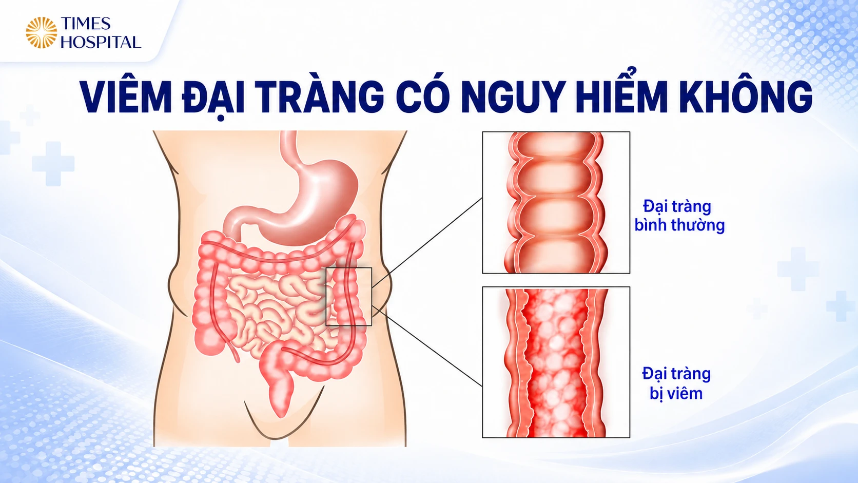 Viêm đại tràng có nguy hiểm không? Dấu hiệu nhận biết và khi nào cần đi khám