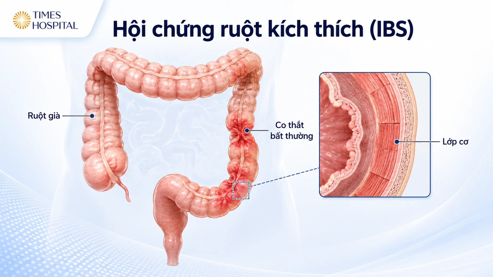 Hội Chứng Ruột Kích Thích: Nguyên Nhân, Triệu Chứng Và Cách Phòng Ngừa