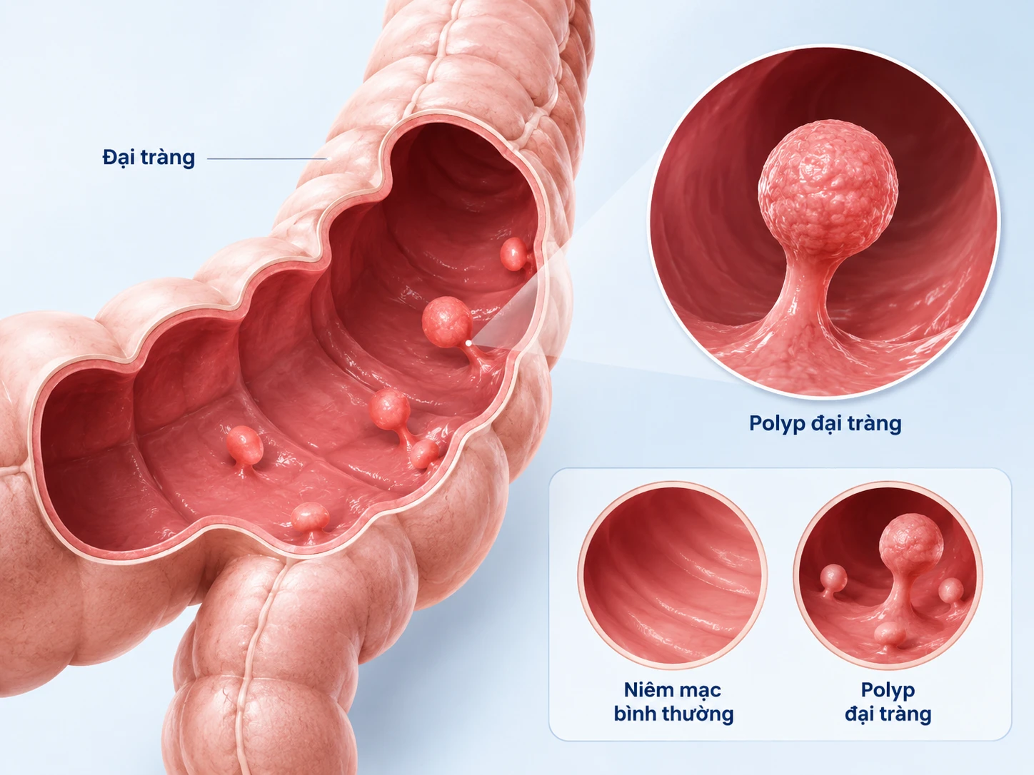 Polyp đại tràng là gì? Dấu hiệu, nguyên nhân và cách xử trí sớm