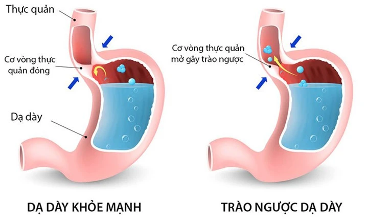 THỨC KHUYA ẢNH HƯỞNG HỆ TIÊU HÓA RA SAO? NHỮNG TÁC HẠI KHÔNG NÊN CHỦ QUAN