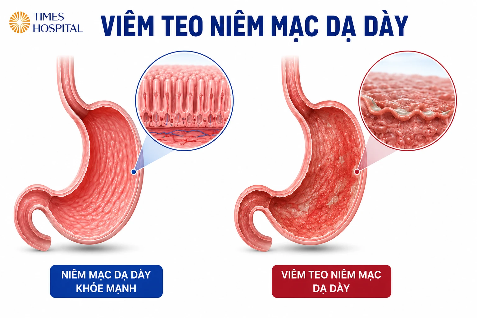Viêm teo niêm mạc dạ dày có nguy hiểm không? Dấu hiệu và cách phòng ngừa