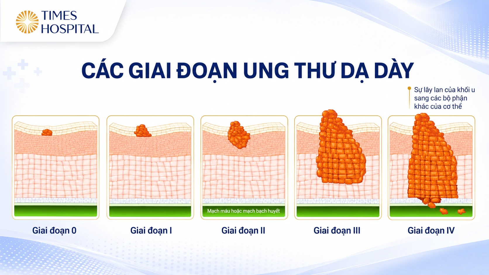 10 DẤU HIỆU UNG THƯ DẠ DÀY THƯỜNG GẶP, ĐỪNG BỎ QUA