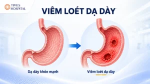 Viêm Loét Dạ Dày: Nguyên Nhân, Triệu Chứng, Chẩn Đoán Và Điều Trị Hiệu Quả