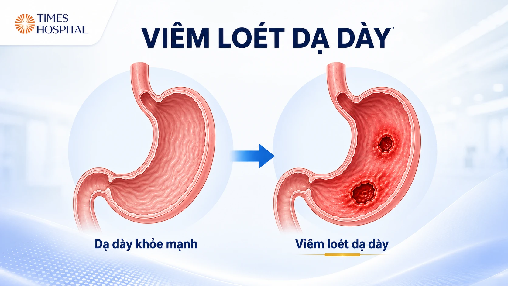 Viêm Loét Dạ Dày: Nguyên Nhân, Triệu Chứng, Chẩn Đoán Và Điều Trị Hiệu Quả