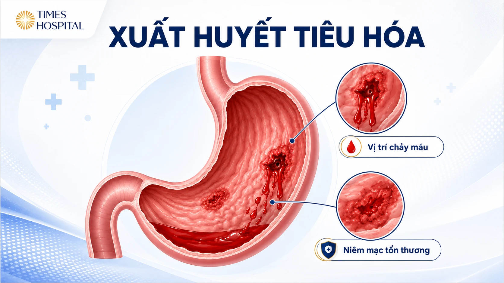 Viêm Loét Dạ Dày: Nguyên Nhân, Triệu Chứng, Chẩn Đoán Và Điều Trị Hiệu Quả